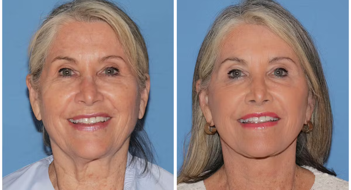 1769039281-before-after-gallery-8nonvhbalnjv