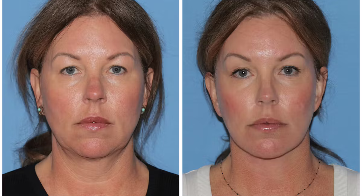 1769039342-before-after-gallery-y7lhi8oepxv9